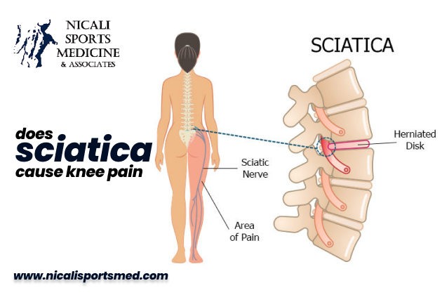 Does Sciatica Cause Knee Pain- Exploring Facts